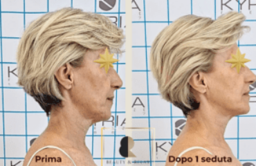 Prima e Dopo 1 seduta di lifting viso metodo VisO'Key Prima-Dopo 1 seduta Lifting Viso Manuale Palermo VisO'Key®Experience Week